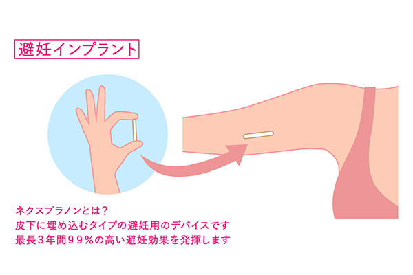 ネクスプラノン